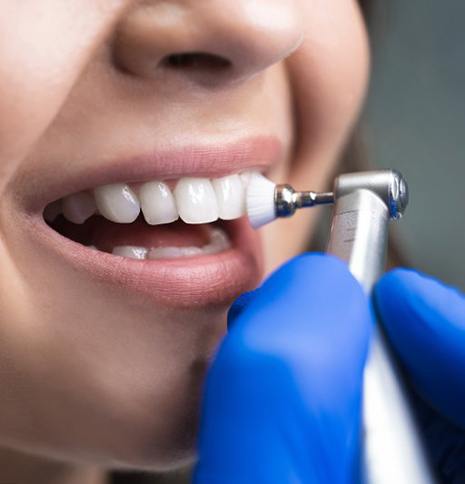 Close up of hygienist polishing a patient’s teeth