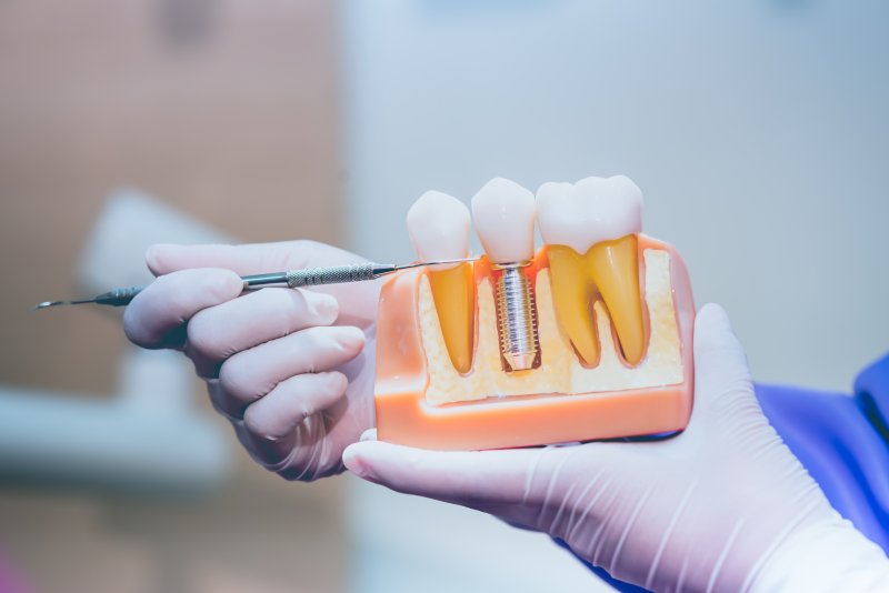 Dentist showing off a model of dental implants